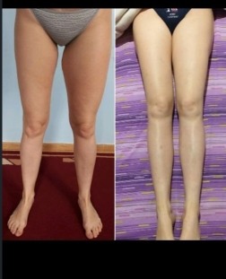 Limfedem nogu - stadijum I