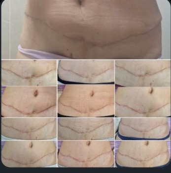 Abdominoplastika - klinički prikaz