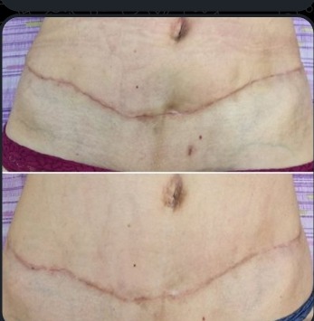Abdominoplastika - napredovanje